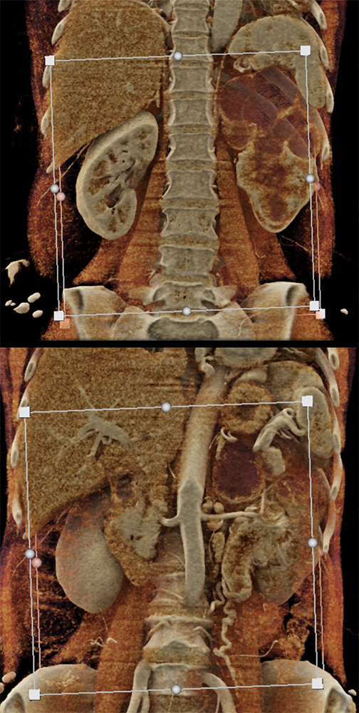 Transitional Cell Carcinoma of the Kidneys