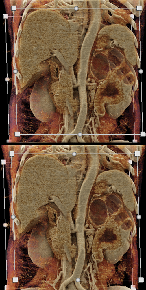 Transitional Cell Carcinoma of the Kidneys