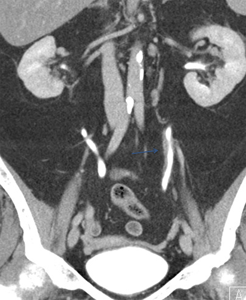 Transitional Cell Carcinoma of the Kidneys