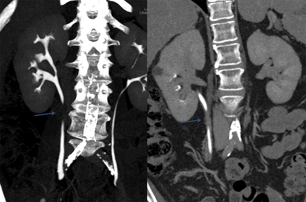 Transitional Cell Carcinoma of the Kidneys