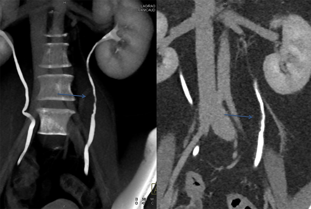 Transitional Cell Carcinoma of the Kidneys