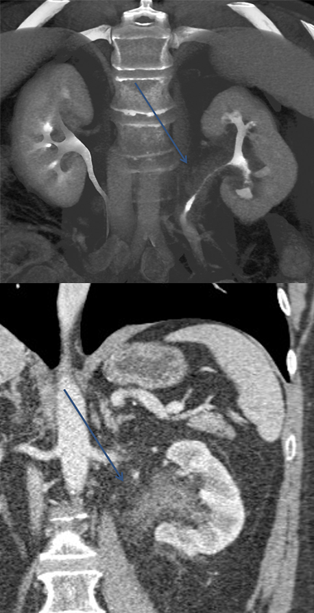 Transitional Cell Carcinoma of the Kidneys