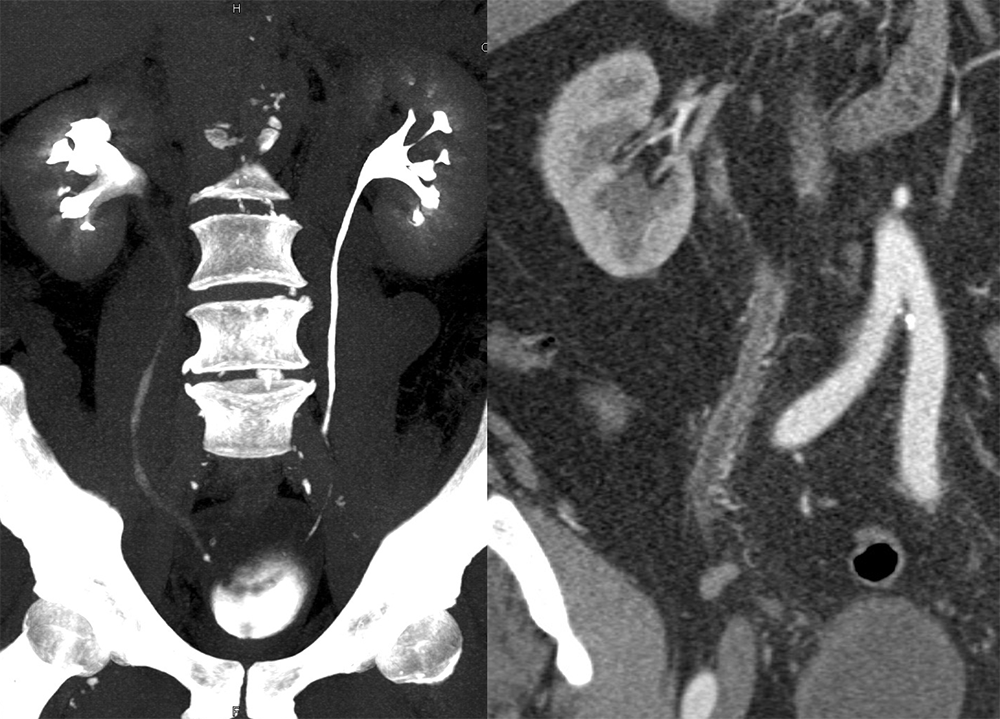 Transitional Cell Carcinoma of the Kidneys