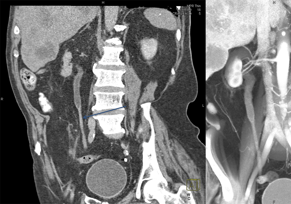 Transitional Cell Carcinoma of the Kidneys