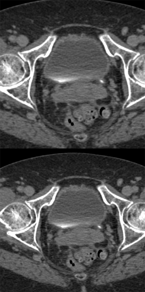 TCC Left Distal Ureter