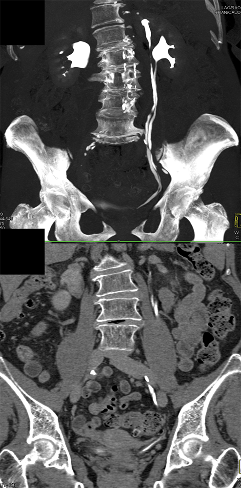 Transitional Cell Carcinoma of the Kidneys