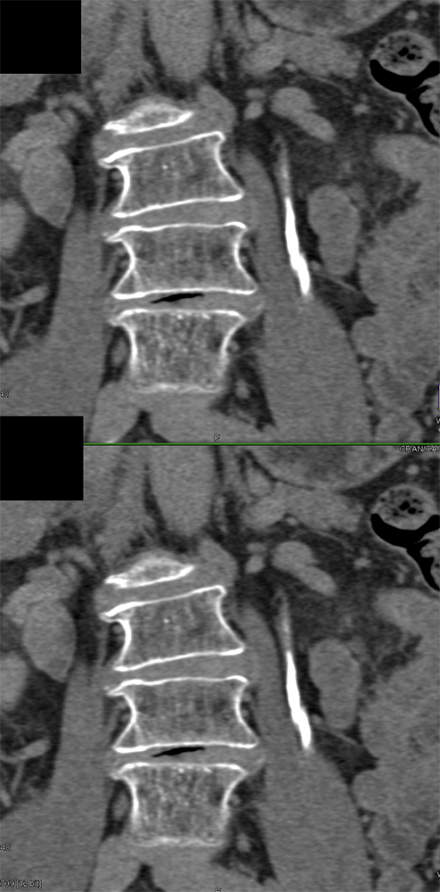 Transitional Cell Carcinoma of the Kidneys