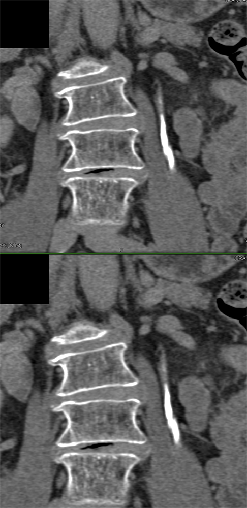 Transitional Cell Carcinoma of the Kidneys