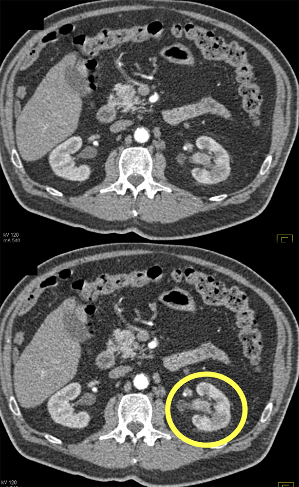 TCC Kidney