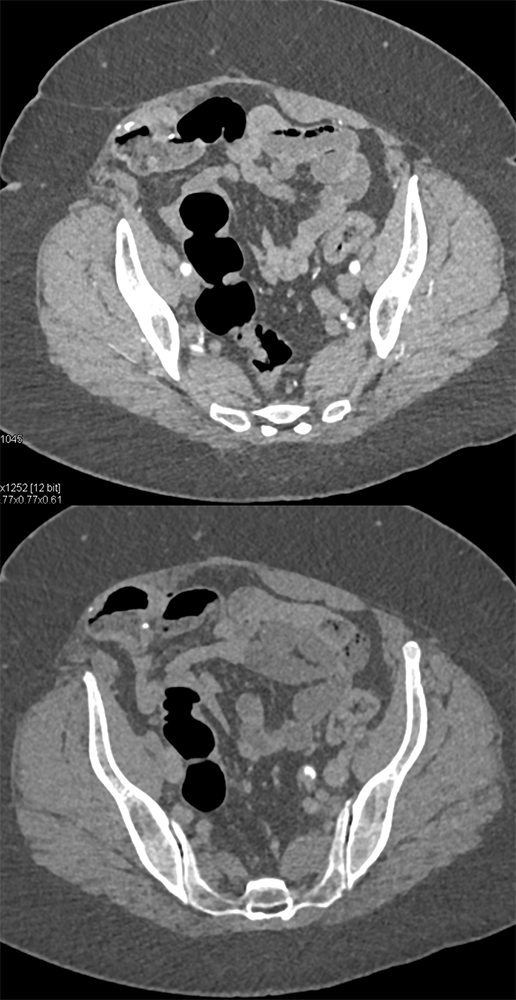 TCC Left Ureter