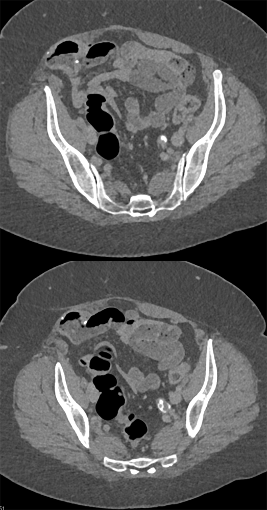 Transitional Cell Carcinoma of the Kidneys