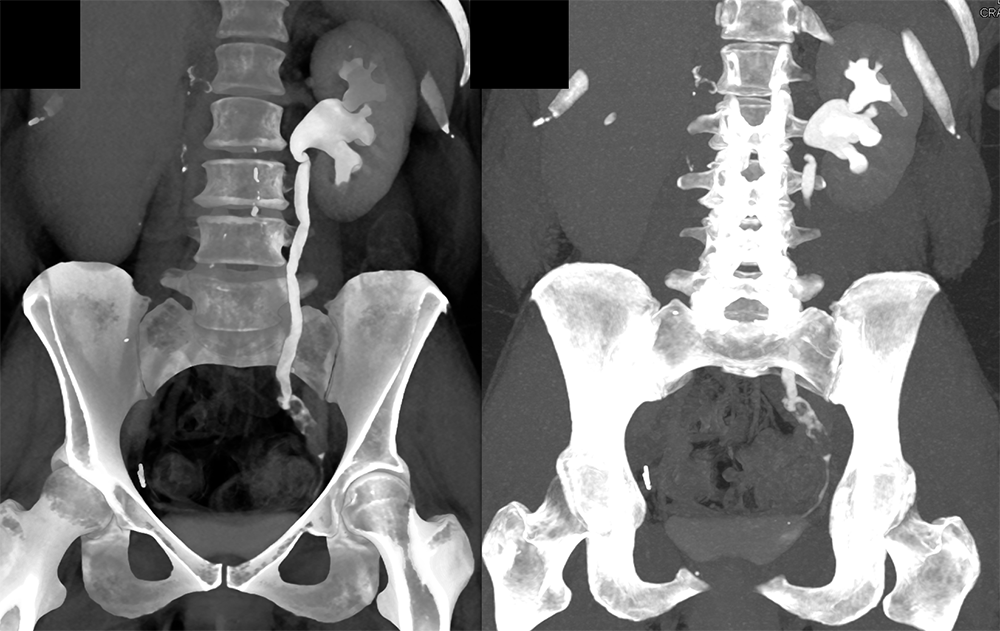 Transitional Cell Carcinoma of the Kidneys