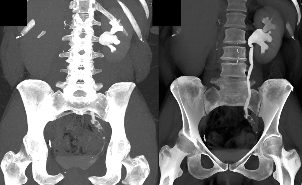 Transitional Cell Carcinoma of the Kidneys