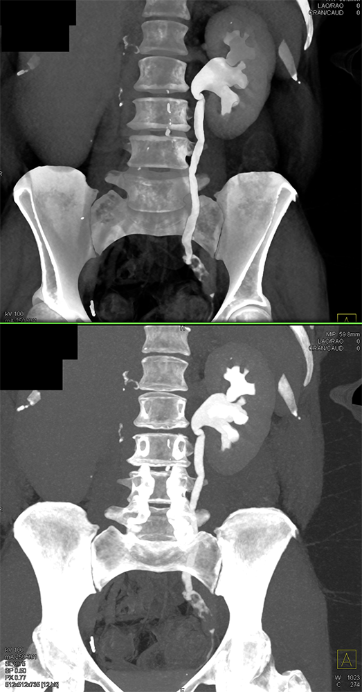 Transitional Cell Carcinoma of the Kidneys