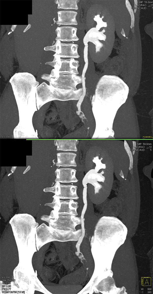 Transitional Cell Carcinoma of the Kidneys