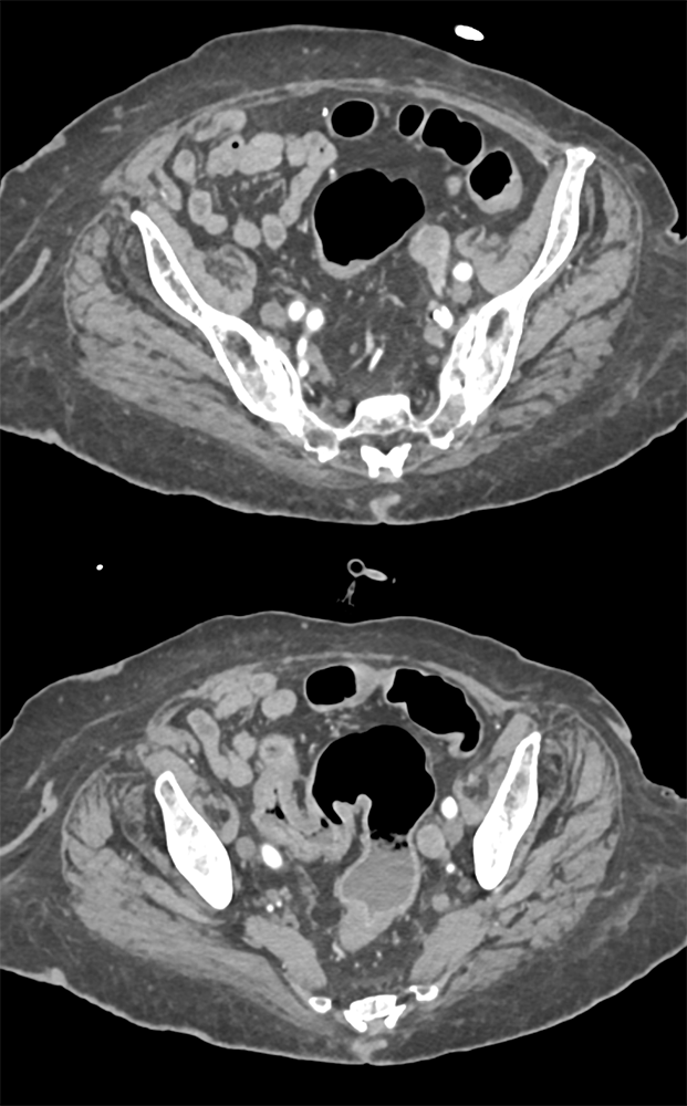 TCC Left Ureter