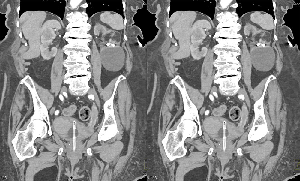 Transitional Cell Carcinoma of the Kidneys