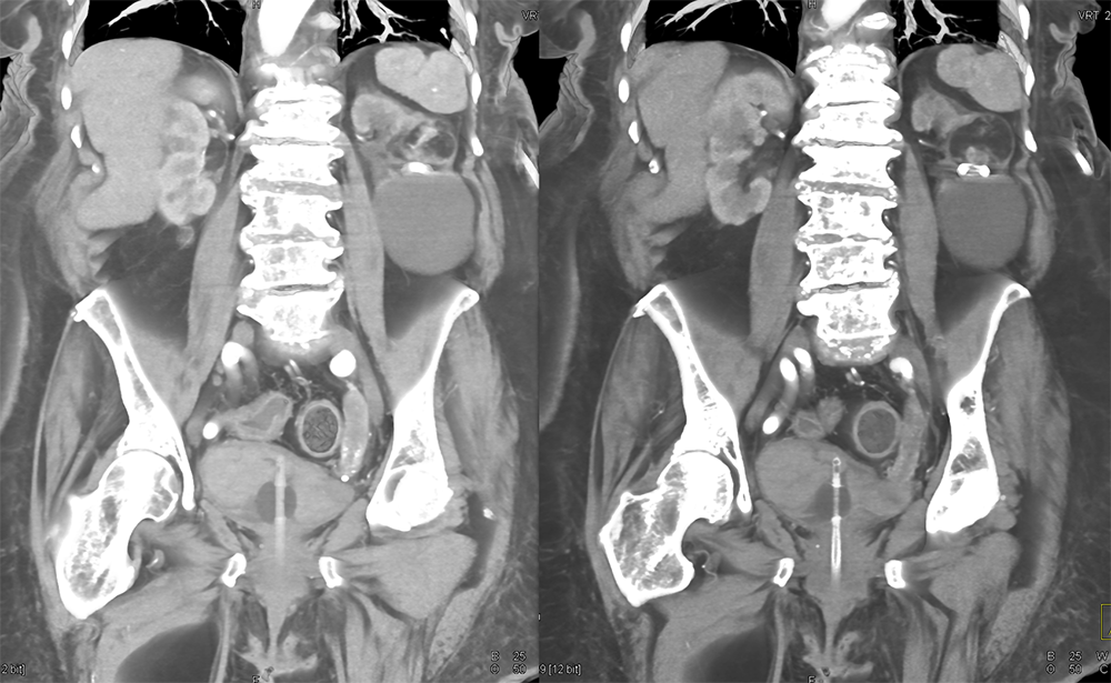 Transitional Cell Carcinoma of the Kidneys