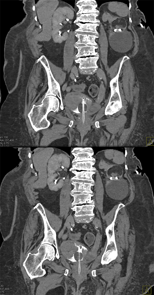 Transitional Cell Carcinoma of the Kidneys