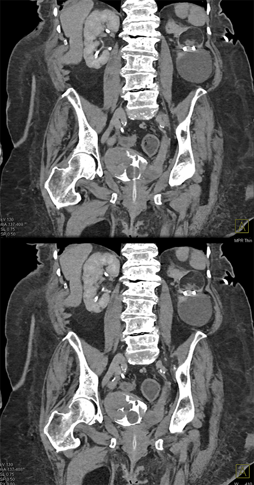 Transitional Cell Carcinoma of the Kidneys