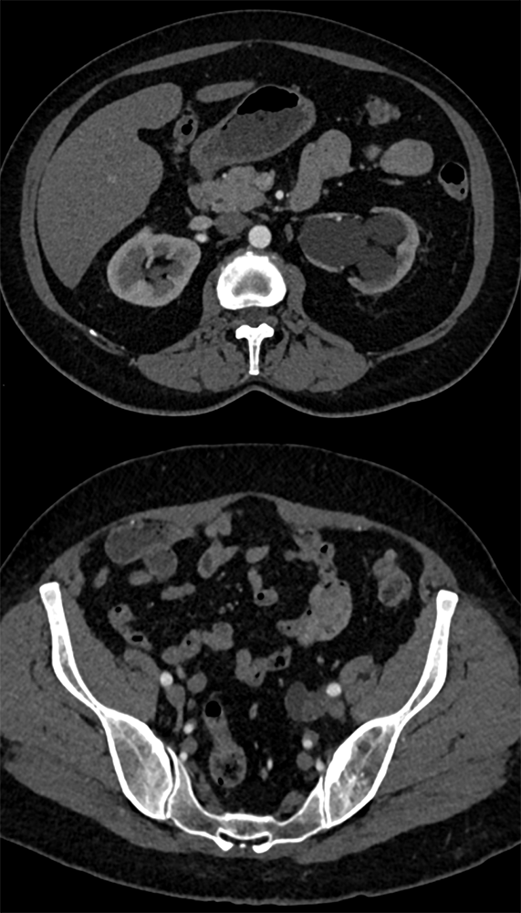 TCC Left Ureter