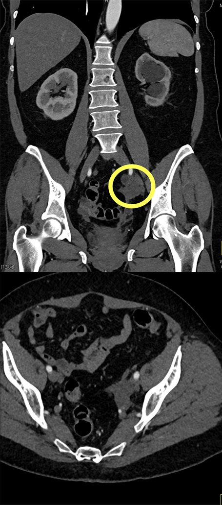 Transitional Cell Carcinoma of the Kidneys