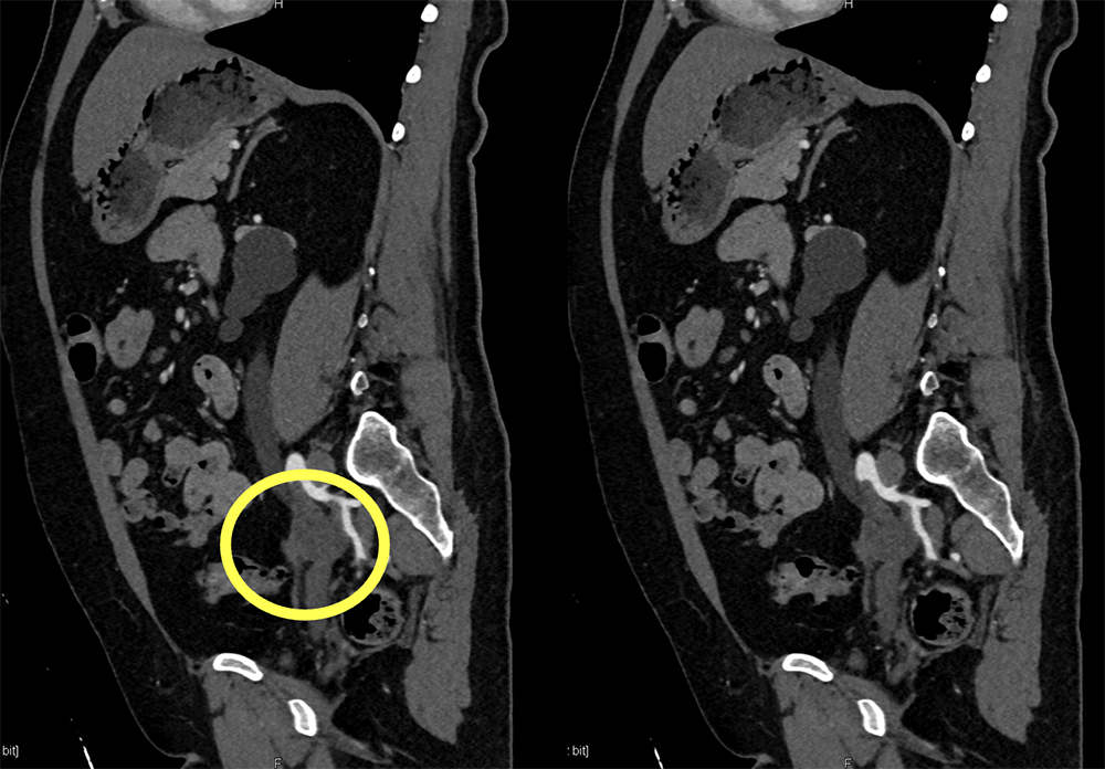 Transitional Cell Carcinoma of the Kidneys