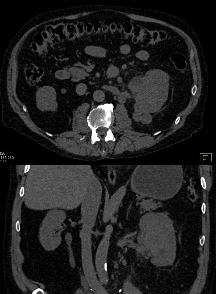 TCC Kidney (had bladder TCC 4 years earlier)