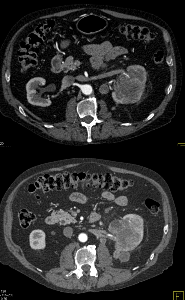 Transitional Cell Carcinoma of the Kidneys