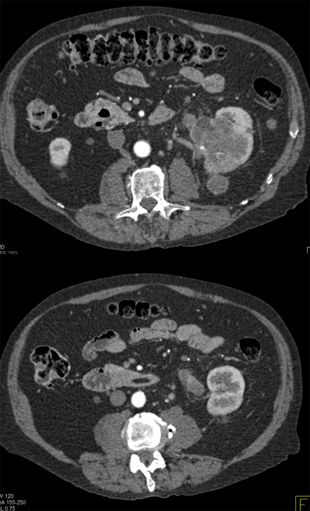 Transitional Cell Carcinoma of the Kidneys