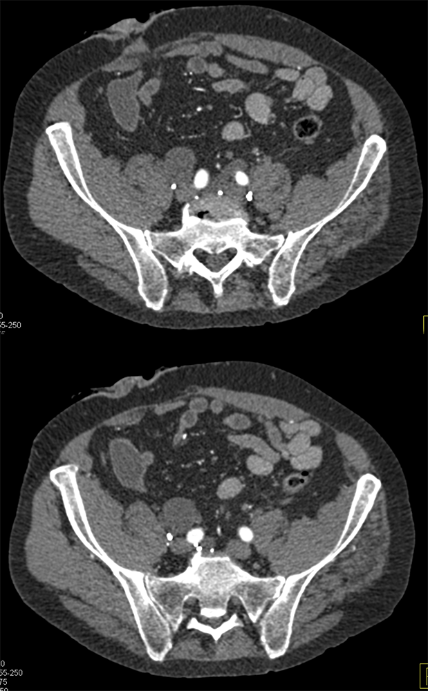 Transitional Cell Carcinoma of the Kidneys