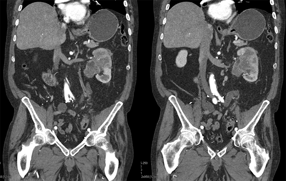 Transitional Cell Carcinoma of the Kidneys