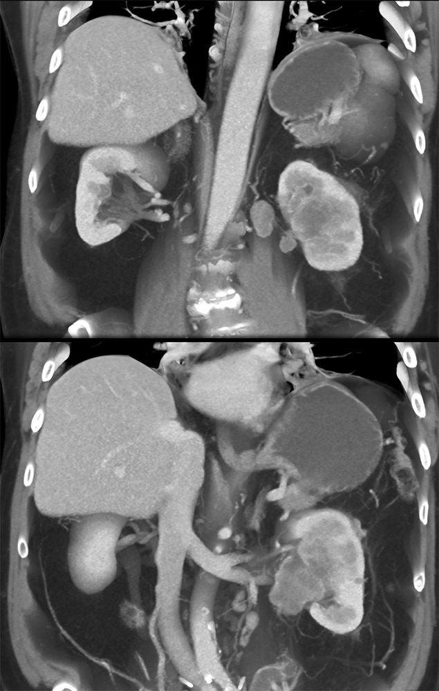 Transitional Cell Carcinoma of the Kidneys