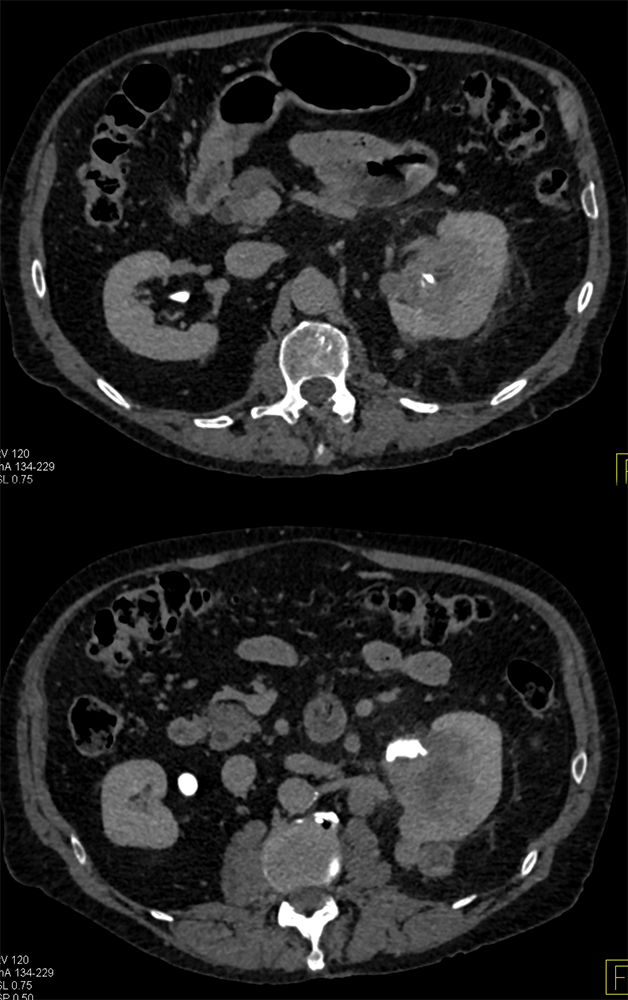 Transitional Cell Carcinoma of the Kidneys