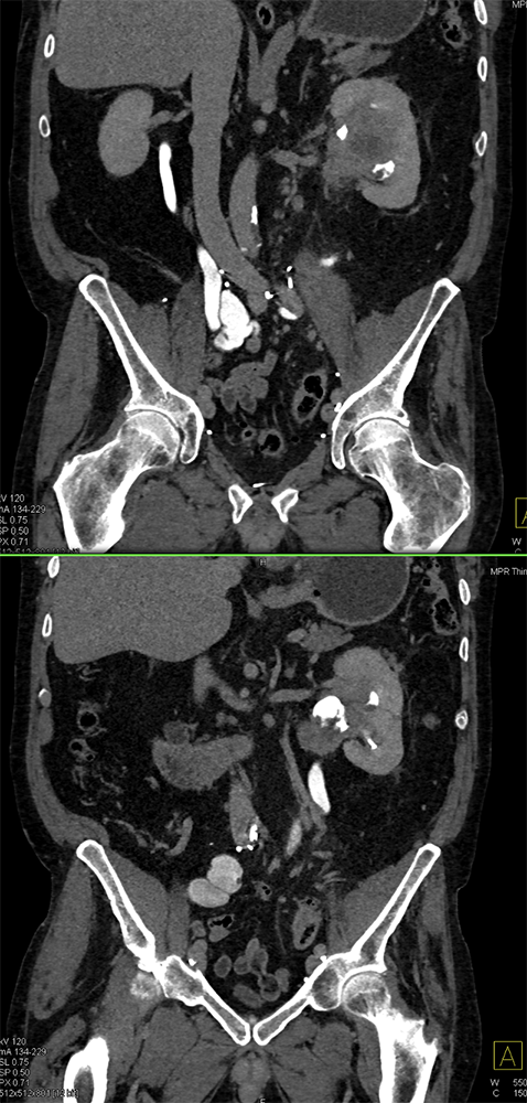 Transitional Cell Carcinoma of the Kidneys