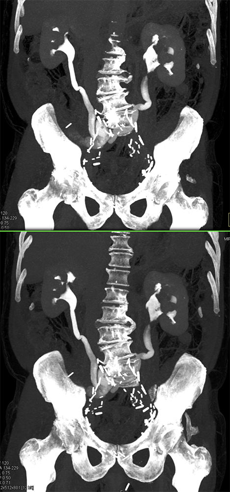 Transitional Cell Carcinoma of the Kidneys