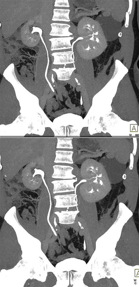 TCC Left Renal Pelvis and Bladder