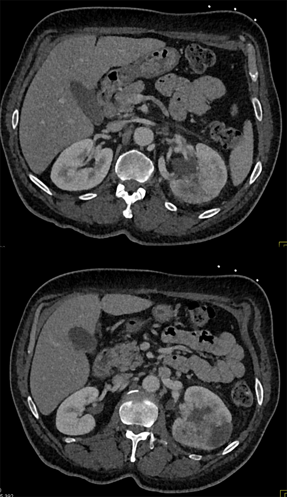 TCC Left Kidney