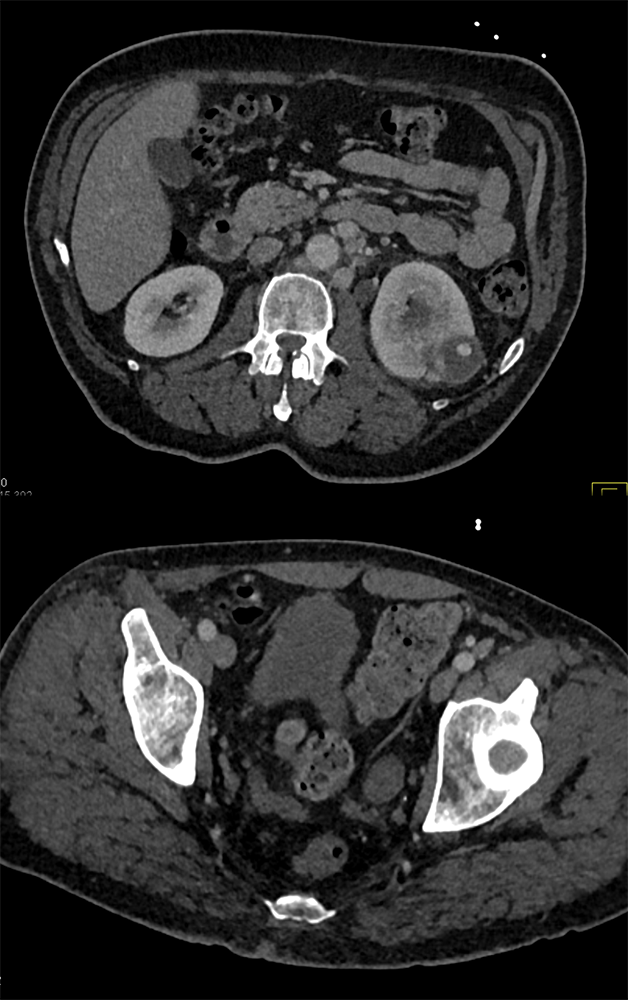 Transitional Cell Carcinoma of the Kidneys