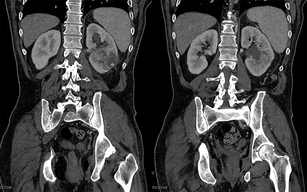 Transitional Cell Carcinoma of the Kidneys