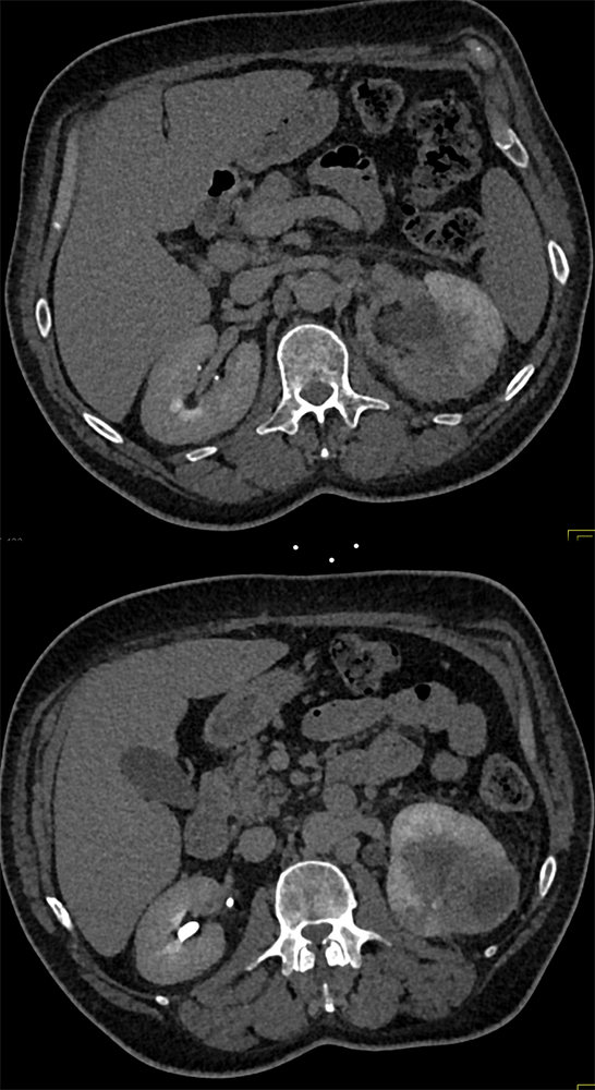 Transitional Cell Carcinoma of the Kidneys