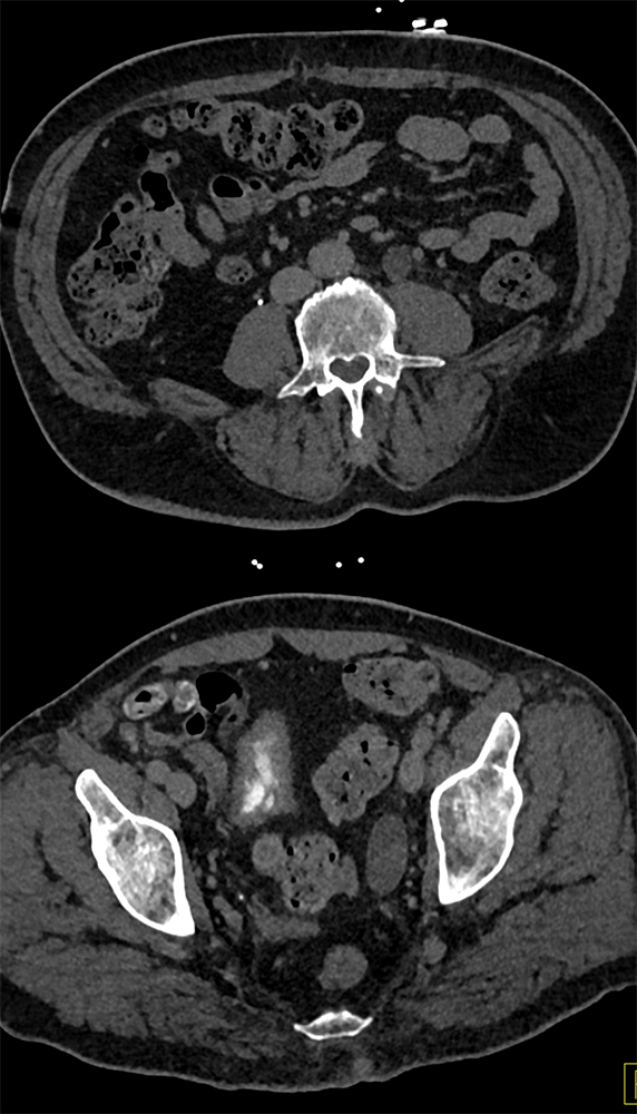 Transitional Cell Carcinoma of the Kidneys