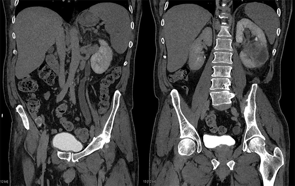 Transitional Cell Carcinoma of the Kidneys