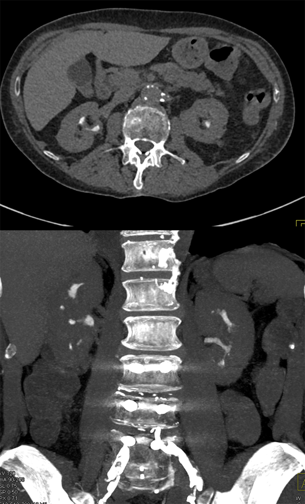 Suspected TCC was Candidiasis