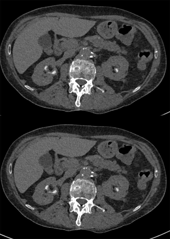 Transitional Cell Carcinoma of the Kidneys