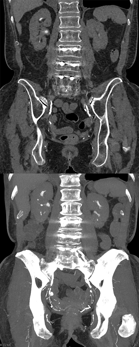 Transitional Cell Carcinoma of the Kidneys