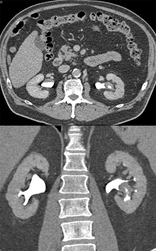 Transitional Cell Carcinoma of the Kidneys