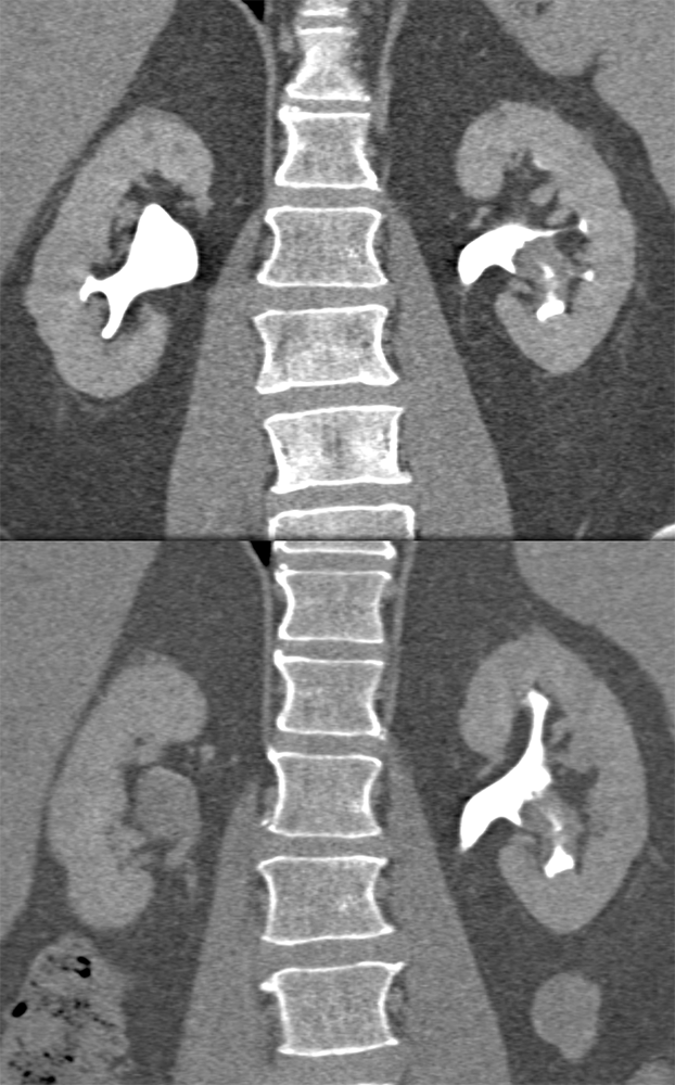 Transitional Cell Carcinoma of the Kidneys