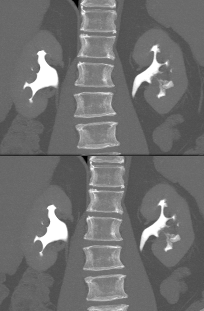 Transitional Cell Carcinoma of the Kidneys