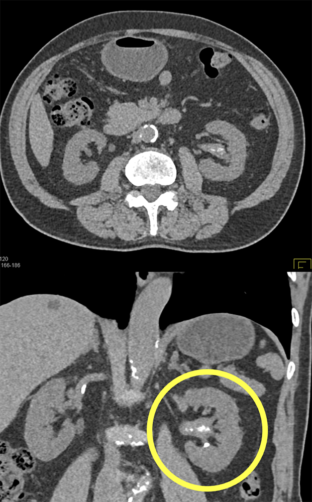 TCC Left Kidney